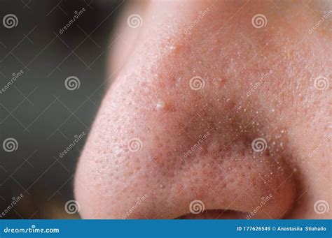 Clogged Pores Problematic Skin Post Acne Scars And Red Festering