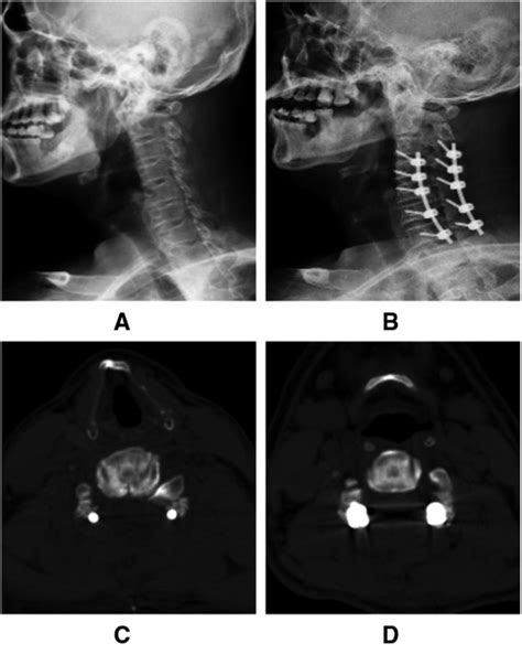 Frontiers Evaluation Of Enlarged Laminectomy With Lateral Mass Screw Fixation In Relieving