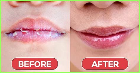 Get Rid Of Dry Lips Dead Skin Or Puffy Eyes Chapped Lips Remedy