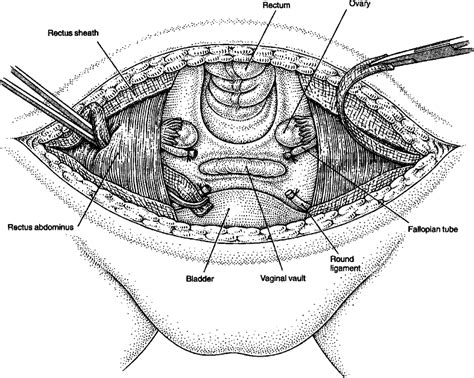 Vaginal Vault Suspension For Prolapse After Hysterectomy Using An Autologous Fascial Sling Of