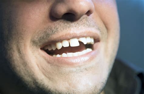 Treatments For Chipped Teeth Boston Ma