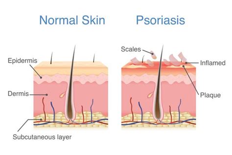 Eczema Vs Psoriasis Whats The Difference Cambridge Therapeutics