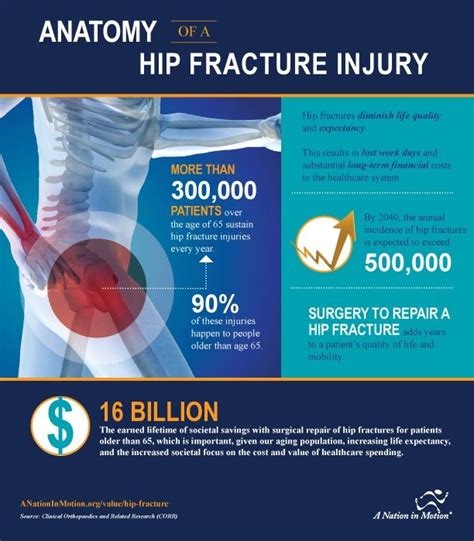 Anatomy Of A Hip Fracture Injury Hip Fracture Healthcare System Life