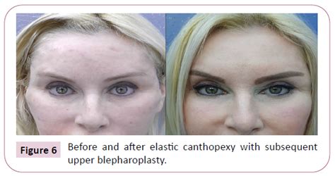 Lateral Canthopexy Before After