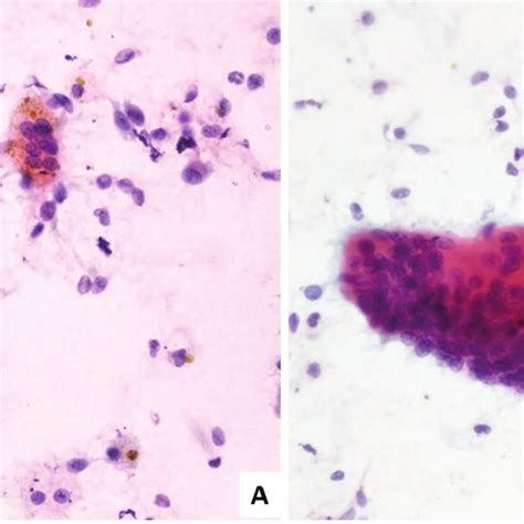 Cytological Findings Of Gctts With Dispersed Histiocyte Like Cells