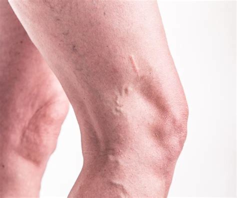 Signs Of A Blood Clot In Your Upper Leg Photo Sign In