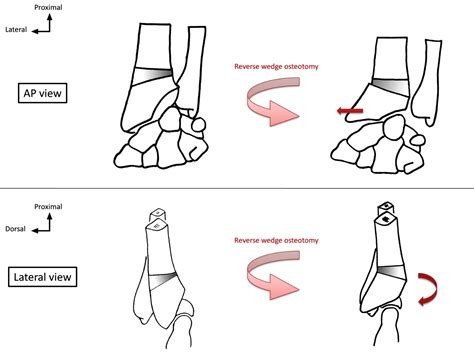Reverse Wedge Osteotomy Of The Distal Radius In Madelung Deformity