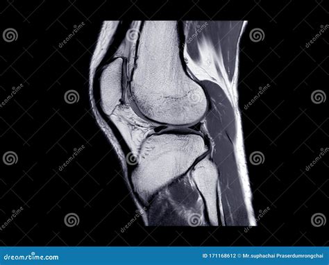 Mri Knee Joint Or Magnetic Resonance Imaging Sagittal View Stock Photo