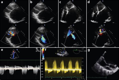 Lessons Of The Month A Forgotten Classic Delayed Diagnosis Of Mitral