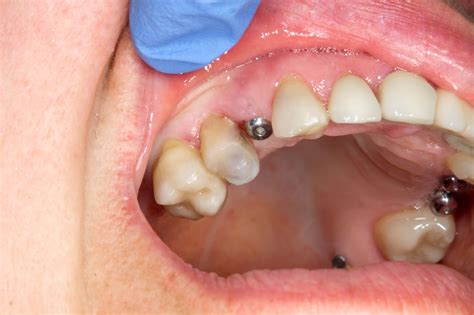 Dental Implants Post Op Care Mathemedics