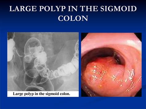 The Colonoscopy Image Showing The Two Sigmoid Colon Polyps Images