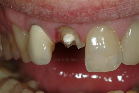 Broken Front Tooth Dental Emergency Sedona Az Dentist Chris Marsh Dmd