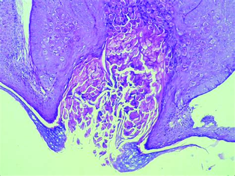 The Craterform Opening Of Molluscum Contagiosum Lesions Discharges Its