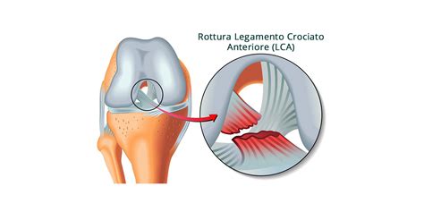 Elastico Il Proprietario Sacerdote Sintomi Rottura Crociato Maligno A Buon Mercato Equazione
