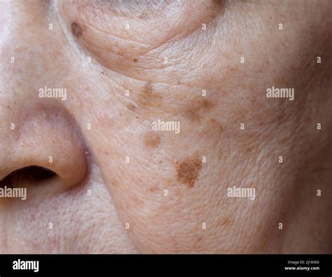 Cheek Patch Woman Hi Res Stock Photography And Images Alamy