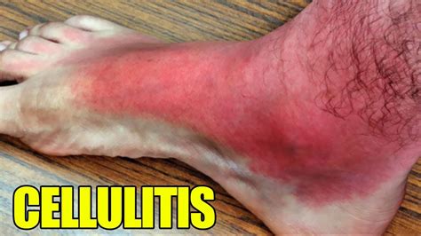 Cellulitis Complicated Cellulitis Infections Abscesses Youtube