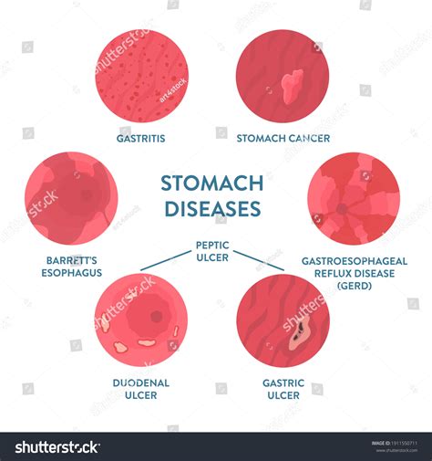 Vektor Stok Types Stomach Diseases Detected By Endoscopy (Tanpa Royalti