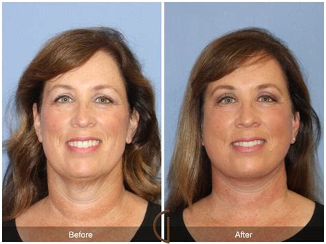 Neck Lift Before And After Photos Patient 03 Dr Kevin Sadati