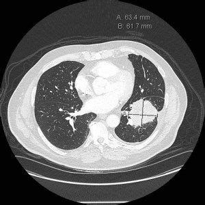 Adenocarcinoma Of The Lung Axial CT Scan Of The Chest With Contrast