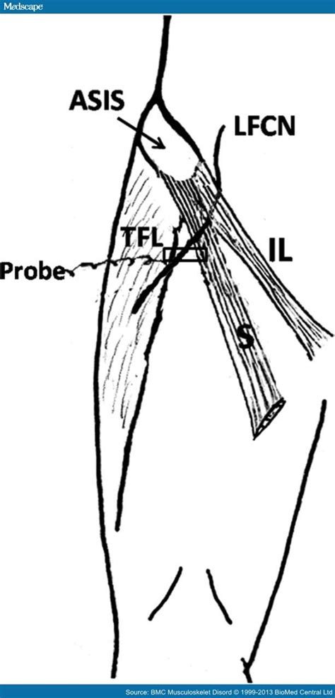 Lateral Femoral Cutaneous Nerve Syndrome