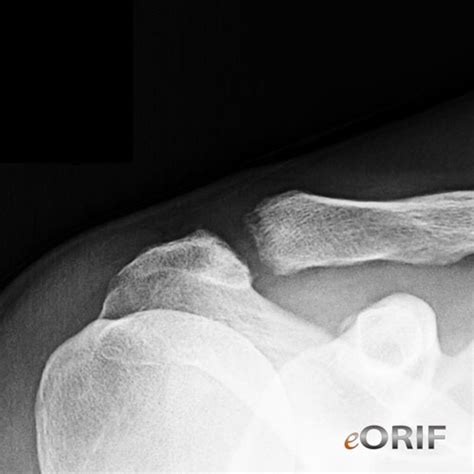 Distal Clavicle Osteolysis M89519 71511 Eorif
