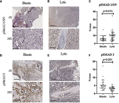 Frontiers Targeting The Bmp Pathway In Prostate Cancer Induced Bone