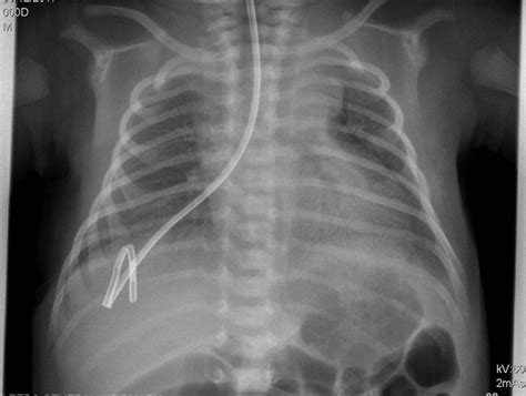 Rare And Unexpected Complication After A Malpositioned Nasogastric Tube