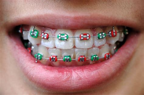 Festive Colours For Your Braces Vancouver Orthodontist