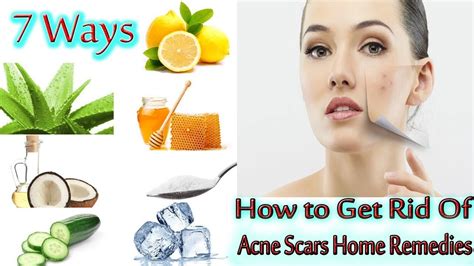15 powerful home remedies for acne } how to get rid acne scars at home youtube