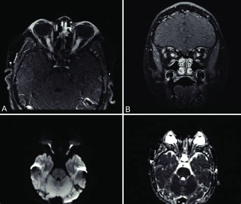 A D Mri T1 Weighted Image Showing Post Contrast Enhancement Of