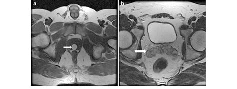 A Case Of Partial Edo Due To Midline Prostatic Cyst A Axial Download Scientific Diagram