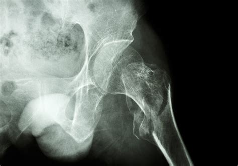 Second Hip Fractures Account For One In 10 Hip Fracture Surgeries Apffa