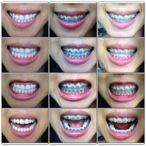 Image Result For Color Options For Braces Tumblr Brackets Dentales Dientes Con Brackets