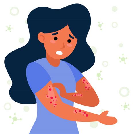 Eczema Illustrations Royalty Free Vector Graphics And Clip Art Istock