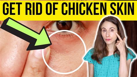 How To Get Rid Of Chicken Skin Under Eyes Dermatologist Youtube