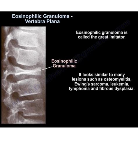 Eosinophilic Granuloma Histology