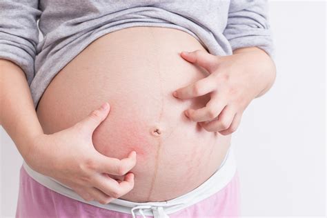 What Is PUPPP Pregnancy Rash How Do You Get Relief The Pulse