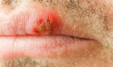 Cold Sore Treatment Get Rid Of Herpes Virus With £795 Liquorice Balm