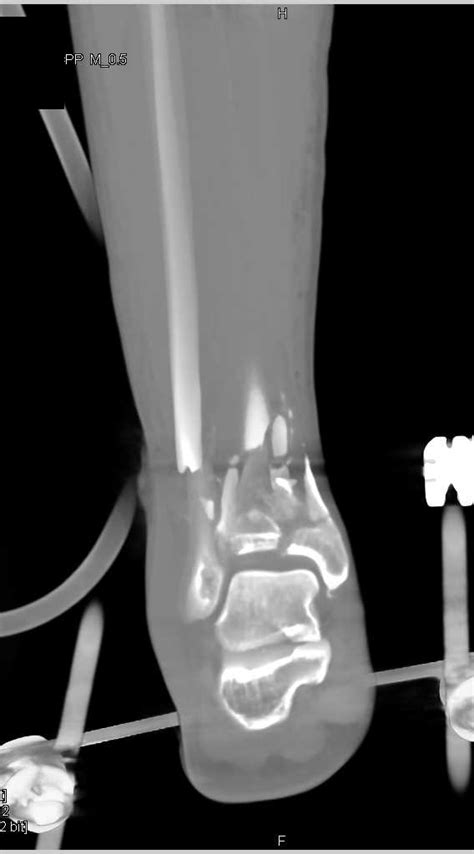 Distal Tibia Fibula Fracture Batmanmadison 105546 Hot Sex Picture