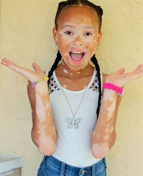 Beinspired Read The Story Of 10 Year Old Girl With Vitiligo Whos