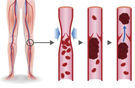 Blood Clot Behind Knee Symptoms Causes And Treatment