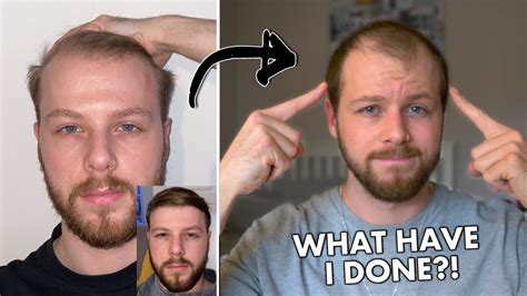 Life After I Shaved My Thinning Hair My Hair Loss Story Continued Youtube