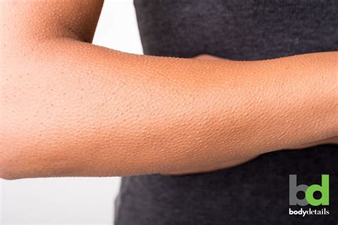 How Laser Hair Removal Can Treat Your “chicken Skin” Body Details Blog