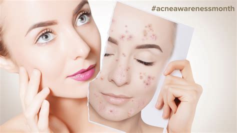 Topical Treatments For Acne From The Zo Skin Health Range Clinetix
