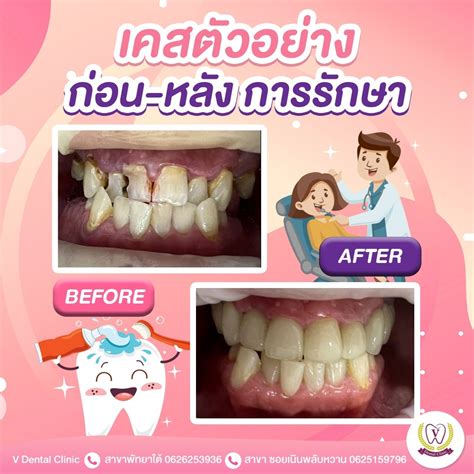 ⭐review การทำครอบฟัน และรักษารากฟัน ที่ V Dental Clinic ⭐บูรณะฟันด้วย