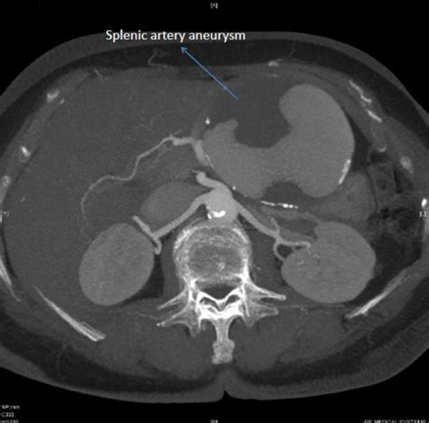 Giant Splenic Artery Aneurysm Treated Surgically With Spleen And