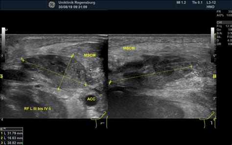 Ultrasound Findings In Actinomyces Infection Of The Neck Augsep 2020