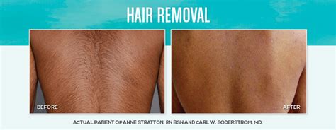 Hair Removal Skin Dimensions Day Spa Medspa And Cosmetic Peoria Il