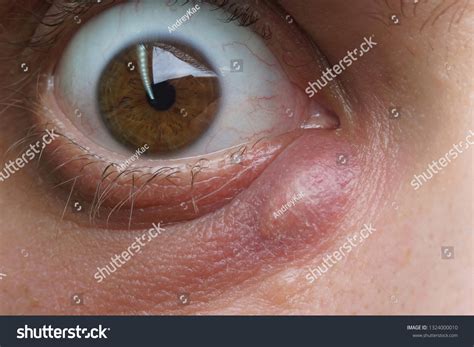 13 Ingrown Eyelashes Images Stock Photos And Vectors Shutterstock