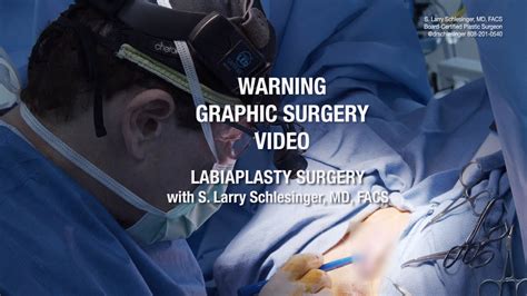 Plastic Surgery Labiaplasty Wedge Technique Youtube